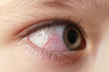 Virüslü kırmızı kan çanağı gözleri, konjonktivit closeup tahriş.
