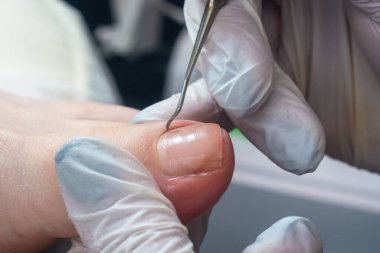 Podolojist ayak parmağındaki nasırları kesmek için bir küp kullanır..