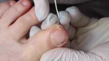 Podolojist ayak parmağındaki nasırları kesmek için bir küp kullanır.