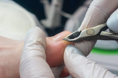 Ayak hastalıkları uzmanı ayak tırnağının etrafındaki kuru deriyi kesiyor..