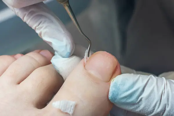 stock image Medical pedicure, podiatrist doing tamponade to a deformed toenail.