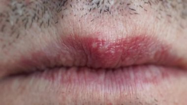 Viral hastalık bir erkeğin dudağında uçuk yapar.