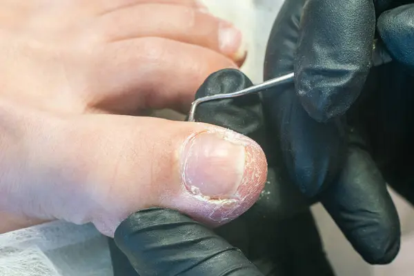 Stock image Podologist uses a curette to remove a callus on the toe.