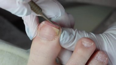 Podolojist ayak parmağındaki nasırları kesmek için bir küp kullanır.