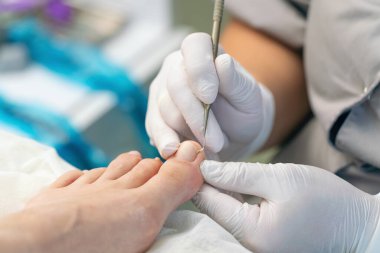 Podolojist ayak parmağındaki nasırları kesmek için bir küp kullanır..