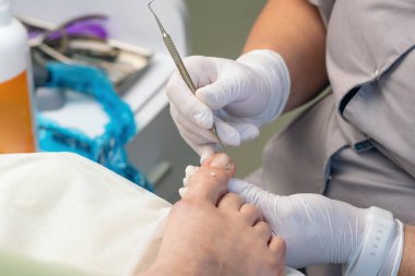 Podolojist ayak parmağındaki nasırları kesmek için bir küp kullanır..