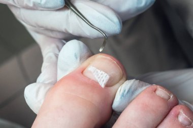 Tıbbi pedikür, ayak tırnağı deforme olmuş birine tampon yapıyor..
