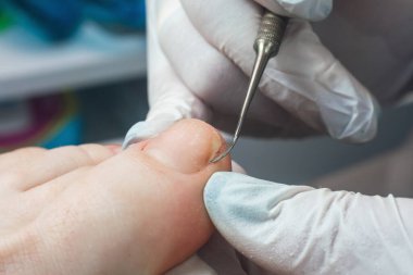 Tıbbi pedikür, ayak tırnağı deforme olmuş birine tampon yapıyor..