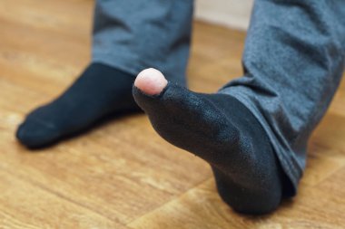 Eski siyah çoraplı bir adamın ayakları, birinin ayak başparmağında bir delik var..