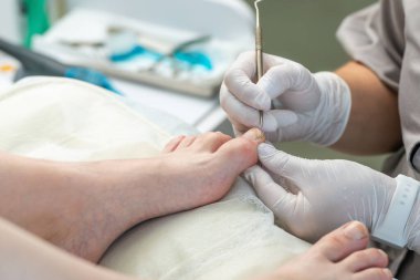 Podolojist ayak parmağındaki nasırları kesmek için bir küp kullanır..