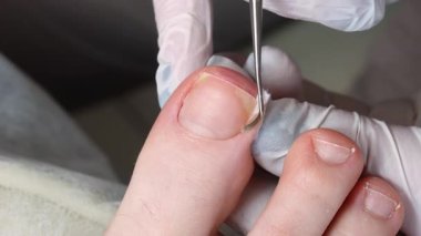 Tıbbi pedikür, ayak tırnağı deforme olmuş birine tampon yapıyor.