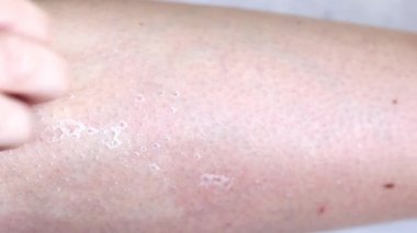 Elim kaşınıyor. Kuru, güneşte yanmış deri. Üst Manzara. Yakın plan..