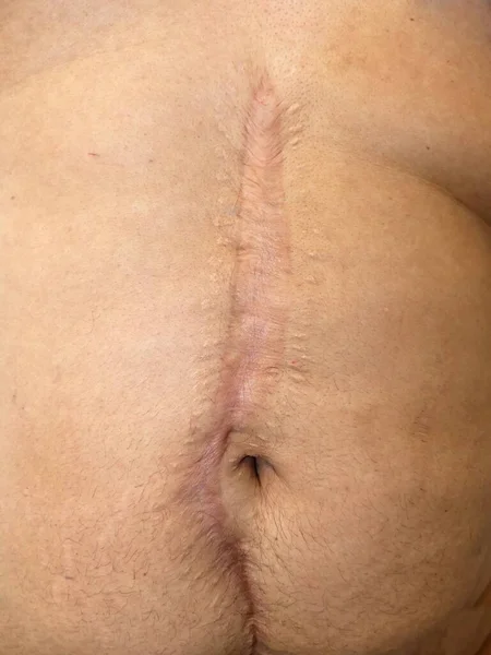 大手術による腹部の大規模な傷跡 ストックフォト