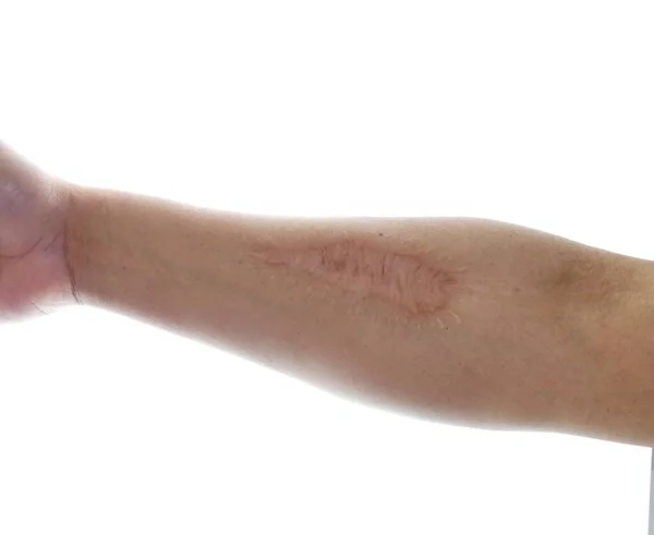外科的介入前腕の傷跡 — ストック写真
