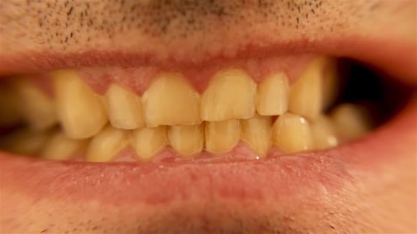 Ukazují Poškozený Chrup Žlutým Smaltem Hodně Tatarského Zubního Zdraví — Stock video