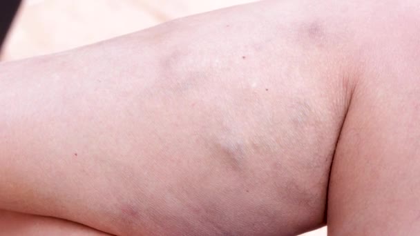 Varisli Damarlar Derin Damar Trombozu Bacaklarda Venöz Yaralanma — Stok video