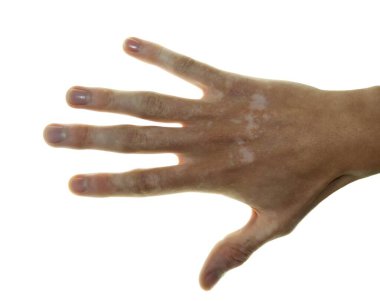 Vitiligo ile El Beyaz Arkaplan Karşısında Cilt Gösterimi