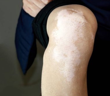 Vitiligo, Depigmente Cilt Yamaları ve Çilli Alanlar ile Bir İnsan Dizinin Yakın Çekimi