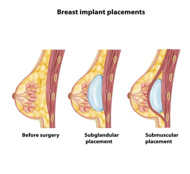 Göğüs implantı yapı diyagramı
