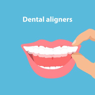 Ağız koruyucusu. Şeffaf diş telleri olan dişler. Dişlerin hizalayıcılara göre hizalanması. Diş hekimliği konsepti. Diş bakımı. Mavi arkaplanda vektör illüstrasyonu izole edildi.