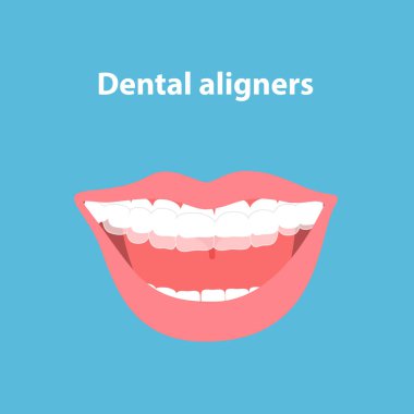 Ağız koruyucusu. Şeffaf diş telleri olan dişler. Dişlerin hizalayıcılara göre hizalanması. Diş hekimliği konsepti. Diş bakımı. Mavi arkaplanda vektör illüstrasyonu izole edildi.