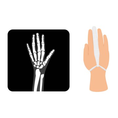 Röntgen filmi ve el travması sargılı yaralı parmak beyaz arka planda izole edildi. Vektör illüstrasyonu