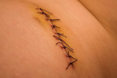 Close-Up of Surgical Stitches on Healing Skin clipart