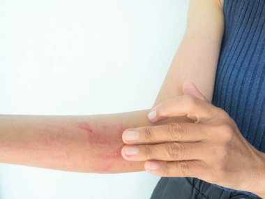 Gıda ve Hava Zehirlenmesinden Ölümcül Olmayan Tür Deri Elli Üreticili Kadın, İlaç Vücut Bakımı Hastalığı Havası, Kol Vücuduna Kalamin Kırmızı Losyonu Tedavisi, Enfeksiyon Ağrısı Hastalığı.