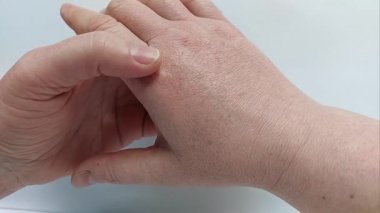 Şiddetli Kuru, Görünür Derili Çatlamış El Derisinin Rahatsız Görünüşü ve Şiddetli Hava ya da Alerjik Tepki Sebebi
