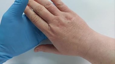 Kuru, Çatlak Eller Hakkında Bir Hastaya Profesyonel Danışmanlık Soğuk Hava veya Alerji Sebebi Olabilir. Doktor muayenesi. Alınan Derin Çatlaklı Flaky Cildi Değerlendiriliyor