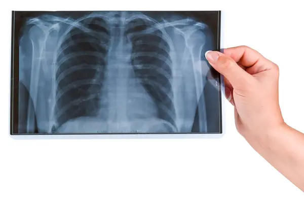 Beyaz arka planda izole edilmiş bir kadın eliyle ciğerlerin röntgenini çektik..