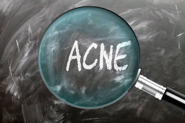 Sivilce. Öğren, çalış ve incele. Sivilcelere daha yakından bakıyorum. Karatahtaya 