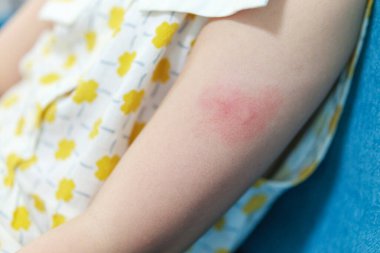 Little girl has skin rash allergy itching and scratching on her arm