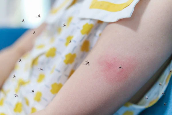 Kislánynak Bőrkiütés Allergiája Van Viszket Karja Szúnyogcsípéstől — Stock Fotó