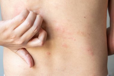 Genç Asyalı adam kaşınıyor ve sırtını kaşındırıyor alerjik kaşınıyor kuru cilt egzama dermatit böceği ısırıkları