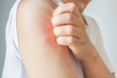 Genç Asyalı adam kaşınıyor ve kolunda kaşıntı var alerjik kaşıntı yüzünden kuru cilt egzama dermatit böceği ısırıkları.