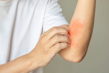 Genç Asyalı adam kaşınıyor ve kolunda kaşıntı var alerjik kaşıntı yüzünden kuru cilt egzama dermatit böceği ısırıkları.