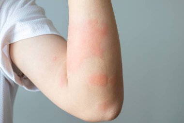 Genç Asyalı adam kaşınıyor ve kolunda kaşıntı var alerjik kaşıntı yüzünden kuru cilt egzama dermatit böceği ısırıkları.