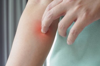 Genç Asyalı adam kaşınıyor ve kolunda kaşındırıyor kuru cilt egzama dermatiti yüzünden.