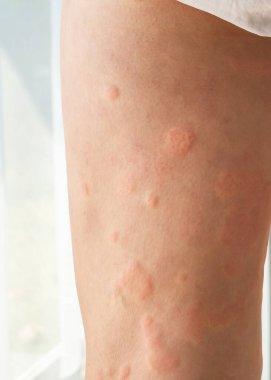 Genç Asyalı adamın bacaklarında kaşındıran kuru deri egzama derisi ısırığından kaynaklanan alerjik deri döküntüsü var.