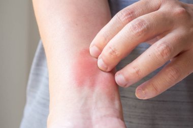 Genç Asyalı adam kaşınıyor ve kolunda kaşıntı var alerjik kaşıntı yüzünden kuru cilt egzama dermatit böceği ısırıkları.