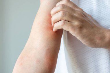 Genç Asyalı adam kaşınıyor ve kolunda kaşıntı var alerjik kaşıntı yüzünden kuru cilt egzama dermatit böceği ısırıkları.