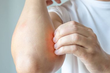 Genç Asyalı adam kaşınıyor ve kolunda kaşıntı var alerjik kaşıntı yüzünden kuru cilt egzama dermatit böceği ısırıkları.