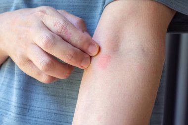 Genç Asyalı adam kaşınıyor ve kolunda kaşıntı var alerjik kaşıntı yüzünden kuru cilt egzama dermatit böceği ısırıkları.