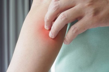 Genç Asyalı adam kaşınıyor ve kolunda kaşındırıyor kuru cilt egzama dermatiti yüzünden.