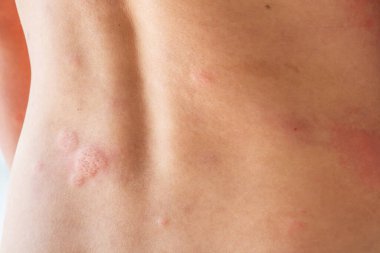 Genç Asyalı adam kaşınıyor ve sırtını kaşındırıyor alerjik kaşınıyor kuru cilt egzama dermatit böceği ısırıkları