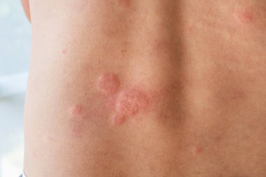 Genç Asyalı adam kaşınıyor ve sırtını kaşındırıyor alerjik kaşınıyor kuru cilt egzama dermatit böceği ısırıkları