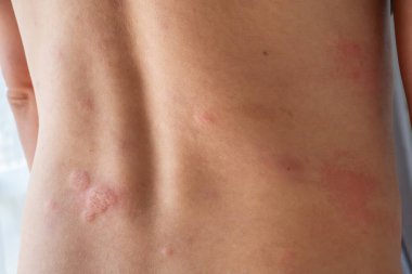 Genç Asyalı adam kaşınıyor ve sırtını kaşındırıyor alerjik kaşınıyor kuru cilt egzama dermatit böceği ısırıkları