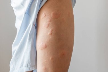 Genç Asyalı adamın bacaklarında kaşındıran kuru deri egzama derisi ısırığından kaynaklanan alerjik deri döküntüsü var.