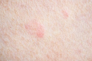 Deri alerjisi kızarıklığı dermatit dokusu kapanıyor.